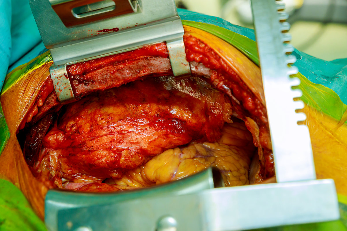 Surgery for coronary artery disease using off-pump technique - Valentyn Semenov