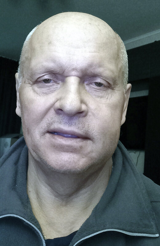 На второй день после имплантации - Валерий Иванович